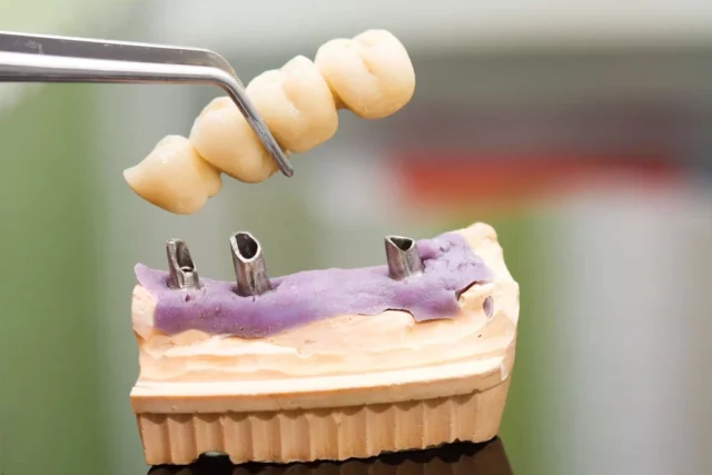 Close-up of a dental bridge model being positioned on dental implants, illustrating dental bridge solutions at Six Point Dental.