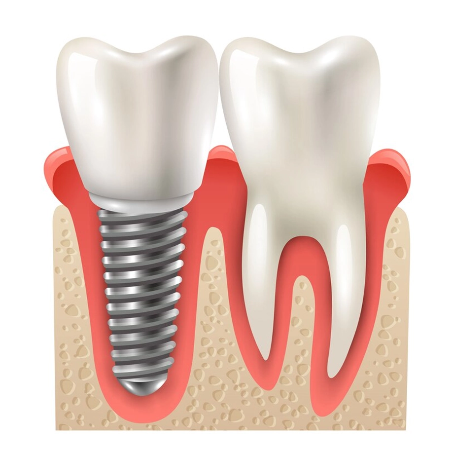 Dental Implants Six Point Dental