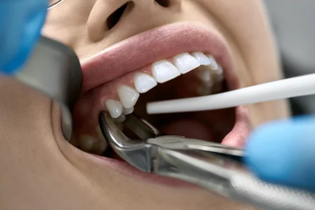 Close-up of a tooth extraction procedure performed at Six Point Dental.