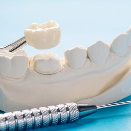 Six Point Dental Crowns Service