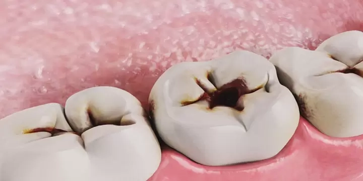 Teeth with cavities shown on pink gum background