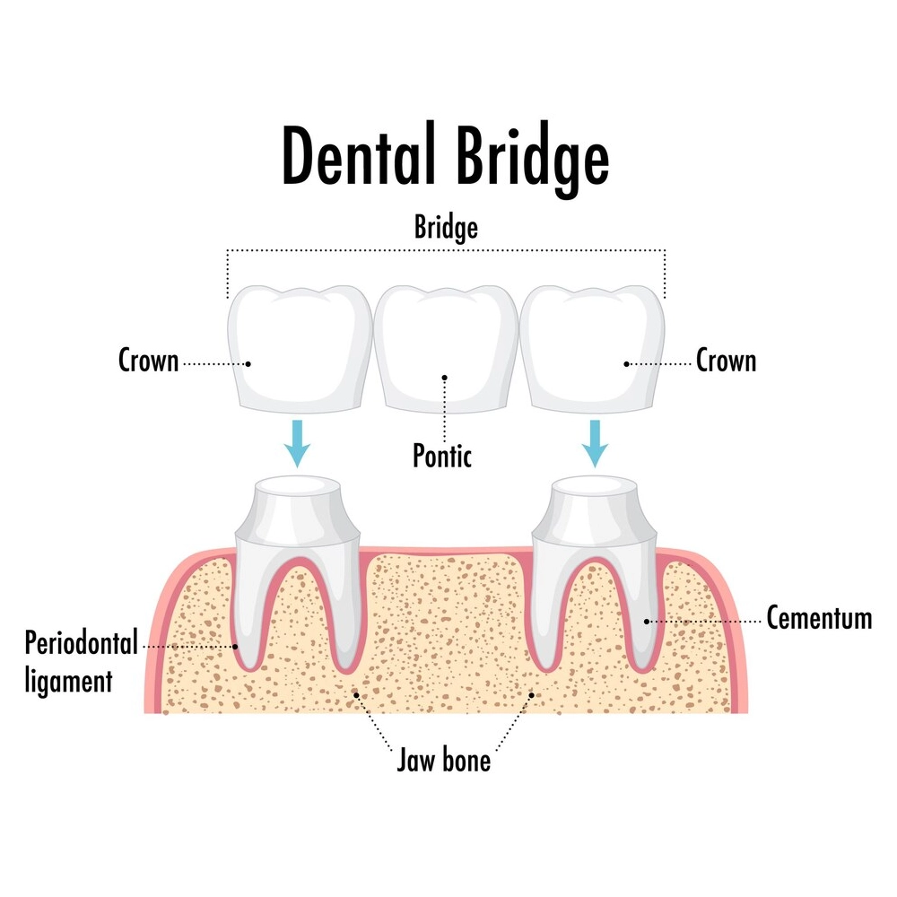Dental Bridge Illustration