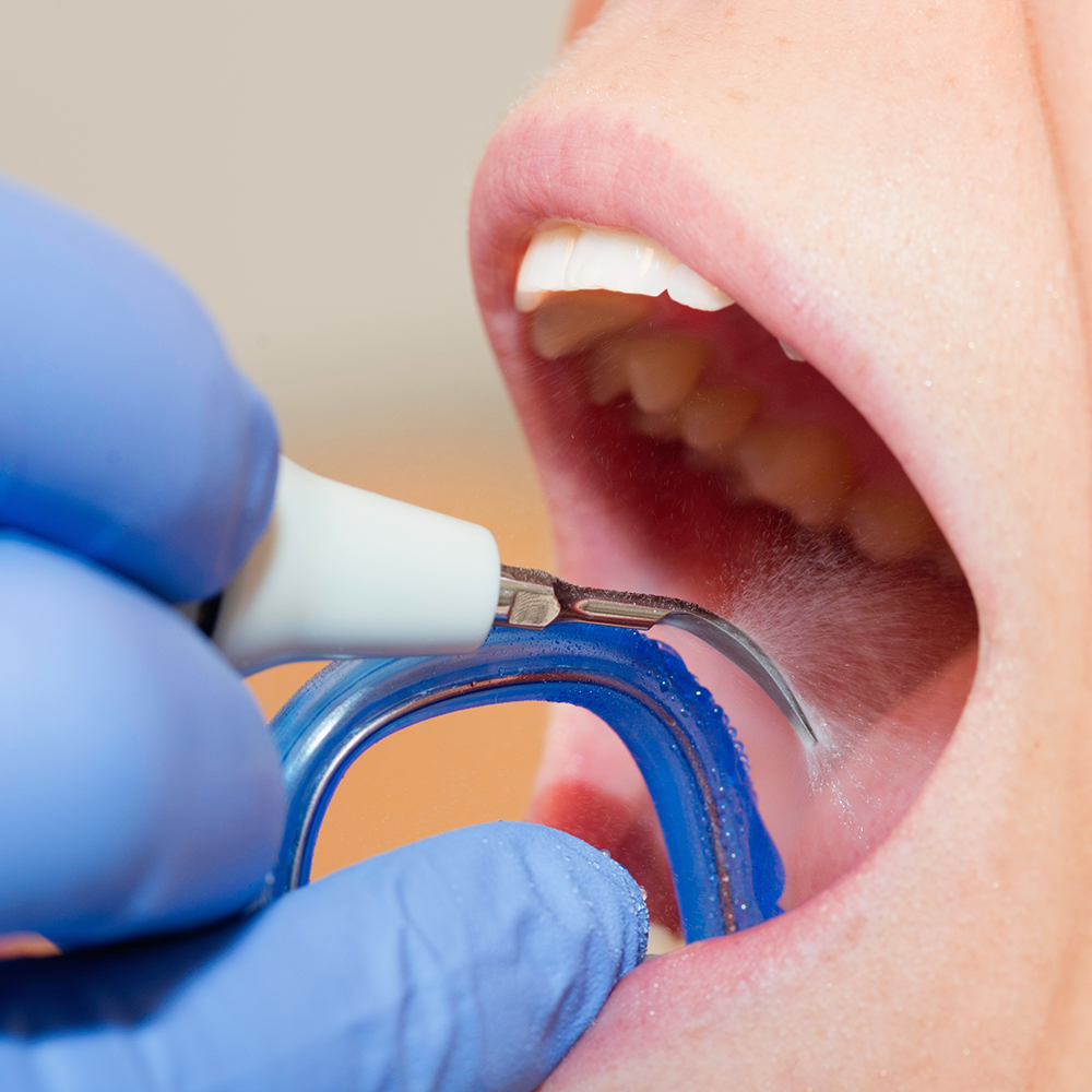 Dental Cleaning performed at Six Point Dental