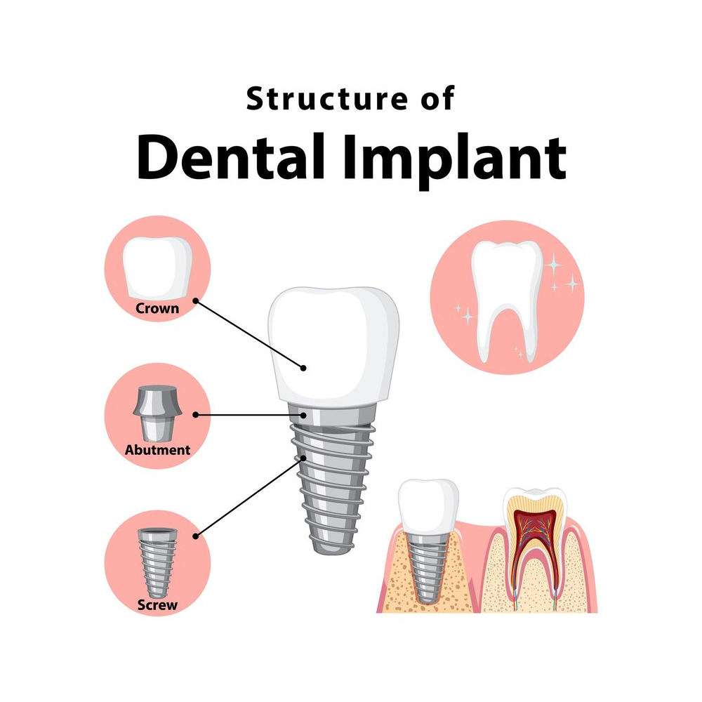 Dental Implant Illustration