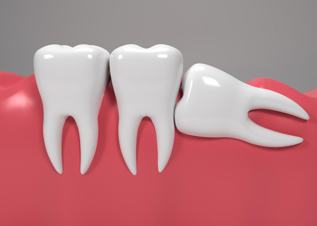 A 3D-rendered image of an impacted wisdom tooth pushing against the adjacent molar, with surrounding gums illustrated in red.